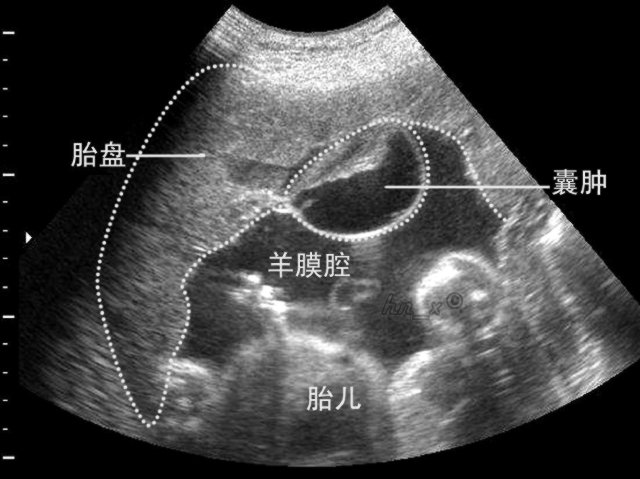 �����ЋD̥�P(p��n)��������ʲô��