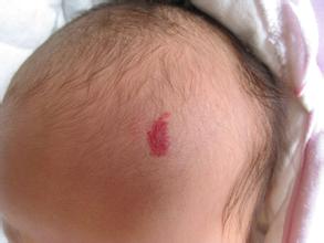 ʲô��̥ӛ��̥ӛ�������γɵ�����Ҫȥ��̥ӛ��