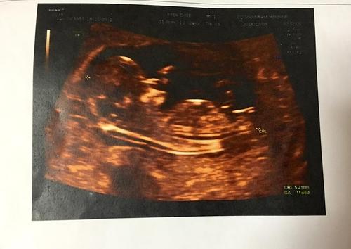 ���ڲʳ���̥���Ƿ���Ӱ푣��ʳ��ĺ�̎����Щ