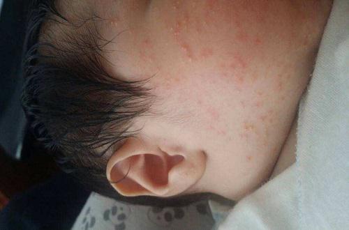 蔬菜也可以預防和治療寶寶濕疹哦!