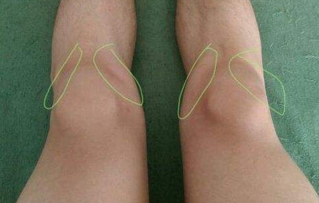 ���ӳ��m(x��)ϥ�wʹҪ���胺ͯ�ɹ��^ȱѪ�ԉ���