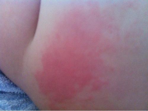 ����Ƥ�w���ۣ����׌����Ƥ�w��ȫ���^����